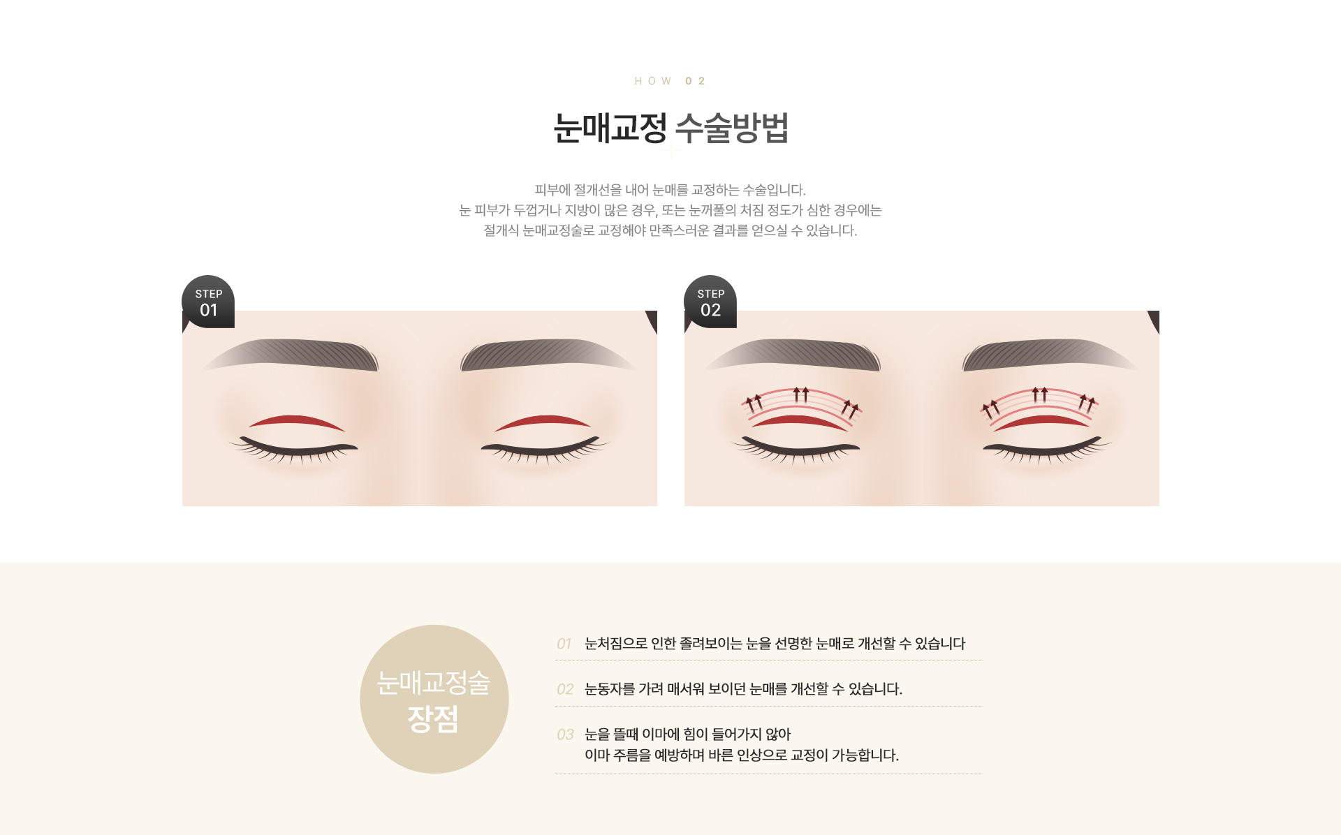 눈매교정/안검하수/재수술 수술방법